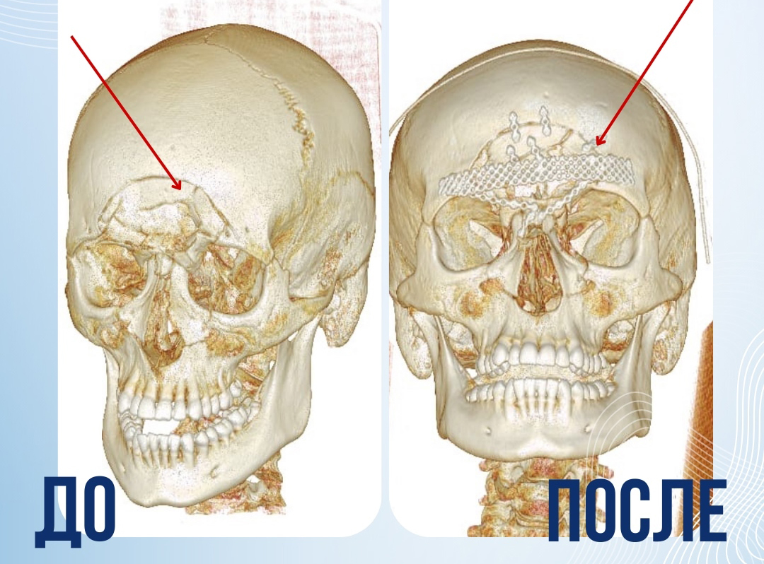 Сотрудники кафедры сочетанных и комбинированных повреждений в составе команды врачей спасли пациента после серьезного ДТП